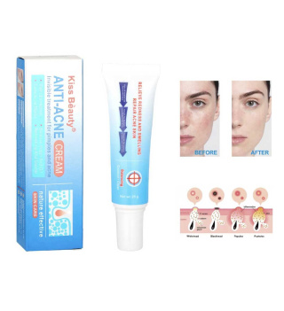 کرم آنتی آکنه 25گرم کیس بیوتی - 02